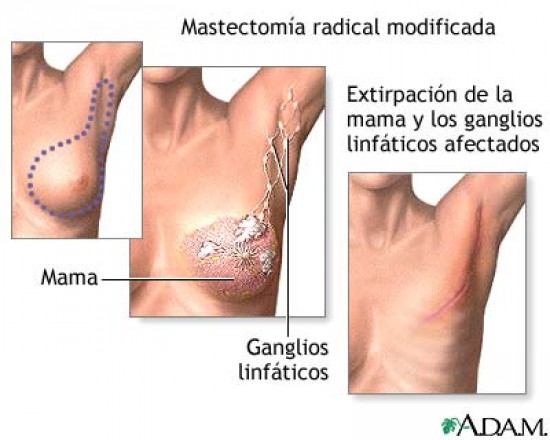 Mastectomia