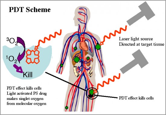 PDT - Photodynamic Therapy