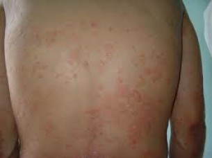  A viszketés a legkevesebb - ilyen súlyos betegségek fenyegetnek a bőrbetegs