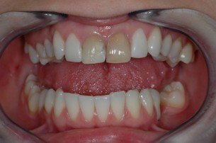  Dr. Büki: Ezért szineződik el a gyökérkezelt fog