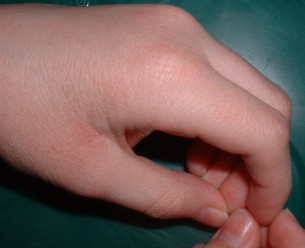  Ez a teendő, ha lekezel a kézekcéma