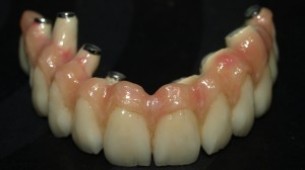  Fogpótlás: Ilyenkor a lehető legjobb választás