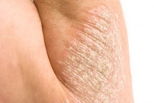  Gyakoribb, mint gondolnád - pszichés bajok a bőrbetegségtől