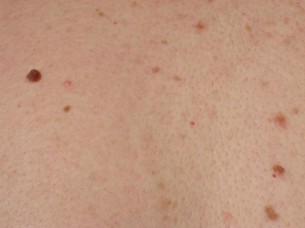  Halálos különbség: Ilyen a bőrrák és ilyen a melanoma