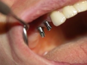  Hiányzó rágófogak - így lehet pótolni őket