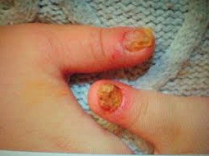  Így kezelik a gyermekkori körömgombát