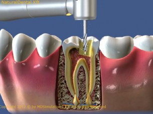  Ilyen fogpanasszal sajnos nincs más megoldás mint a gyökérkezelés