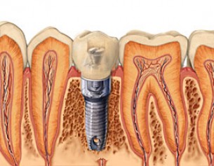  Implantáció - Hosszú idő után is megoldás