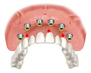  Kétféle implantációs fogpótlási eljárás létezik