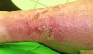  Lábszárfekély - Így kell helyesen kezelni