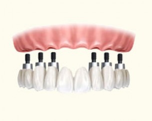  Rögzített fogpótlás - Teljes fogsor hiánya esetén lehetséges?