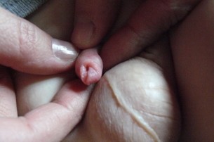  Tünet: Visszatérő gyulladás a makkon