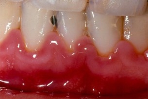  Vérző fogíny: Vedd komolyan, ilyen bajt jelez!