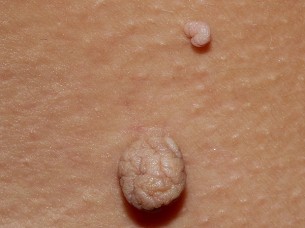  Vírusos bőrhiba? - el kell távolíttatni!