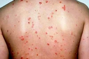  Visszataszító betegség: Biztosan nem fertőz a pikkelysömör?