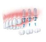 A fogpótlás XI. századi módja - olyan, mint a Lego