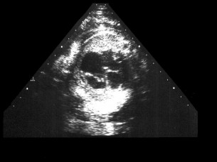 A legkorábban kiszűrhető magzati szívhibák