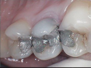 Amalgámtömés a fogban: allergiát és gyulladást is okozhat