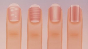 Árulkodó jel: kóros barázdák a körmön