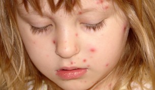 Bárányhimlőtől az övsömörig - egy 100 százalékosan fertőzőképes vír