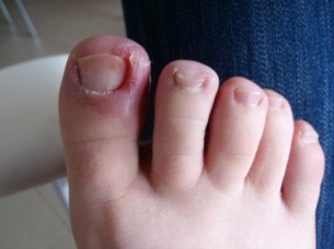 Benőtt köröm: Rosszul vágod a körmöd?