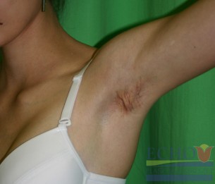 Beteg izzadságmirigyek: Nem szabad begyulladni