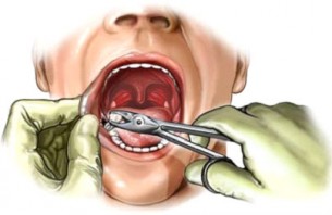 Dr. Büki: Rejtőzködő bölcsességfog