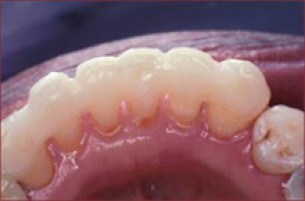 Egy tinédzsernek mozoghat a foga?