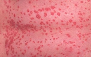 Ezek a pikkelysömör kezelésének irányelvei