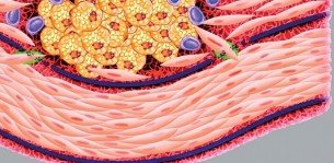 szívelégtelenség bno lehetséges-e IVF-t hipertóniával végezni