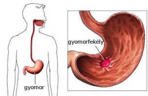 Ezeket edd a gyomorfekély ellen