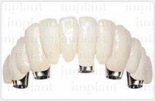 Ezt jelenti az ideiglenes fogpótlás!