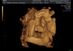 Ezt kell tudnod a genetikai rendellenességekről