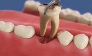 Figyelem! Foghúzás után ezek a tünetek óriási bajt jeleznek