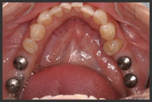 Fogimplantáció - ilyenkor a legjobb megoldás ez