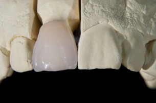 Fogimplantátum - Számít a márka és a típus?