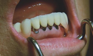 Fogpótás - Vigyázz! Ez a típus hamis biztonságérzetet ad