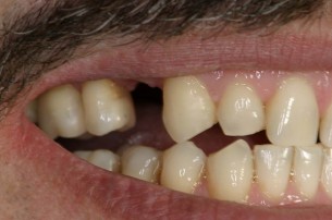 Fogpótlás - ilyenkor a legmodernebb módszer nem a legjobb