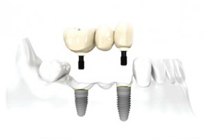 Fogpótlás: Ilyenkor nincs jobb, mint az implantáció!