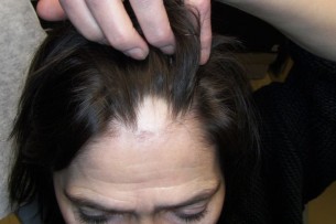Foltos hajhullás fiatalon: Autoimmun betegséget jelezhet!