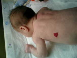 Furcsa piros pötty - ezt lehet tenni az ér-anyajeggyel