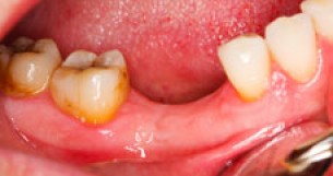 Gennyes lyuk a fogon - Eltávolítani, vagy megtartani