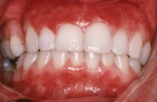 Gyulladt íny? Tudd meg, mitől