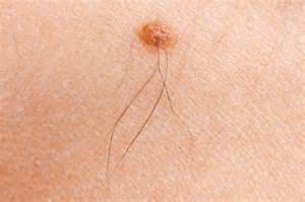 Halálos anyajegy - ártalmatlannak látszó kóros elváltozás