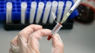 HIV-szűrés: Mikor biztos az eredmény?