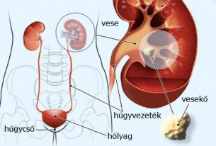 Heveny húgyhólyag-gyulladás