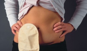 Így egyél, sztóma esetén