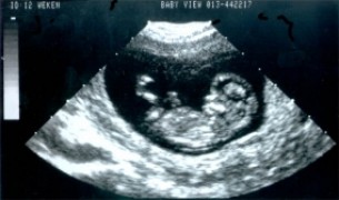 Így jönnek egymás után a prenatális szűrések