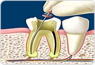Így okozhat nagy galibát a gyökérkezelés