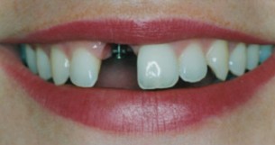 Így pótolható a hiányzó fog